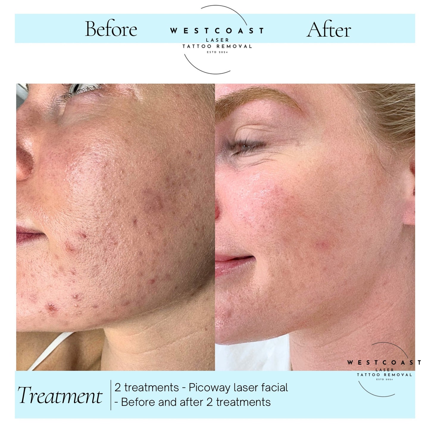 Laser Facials