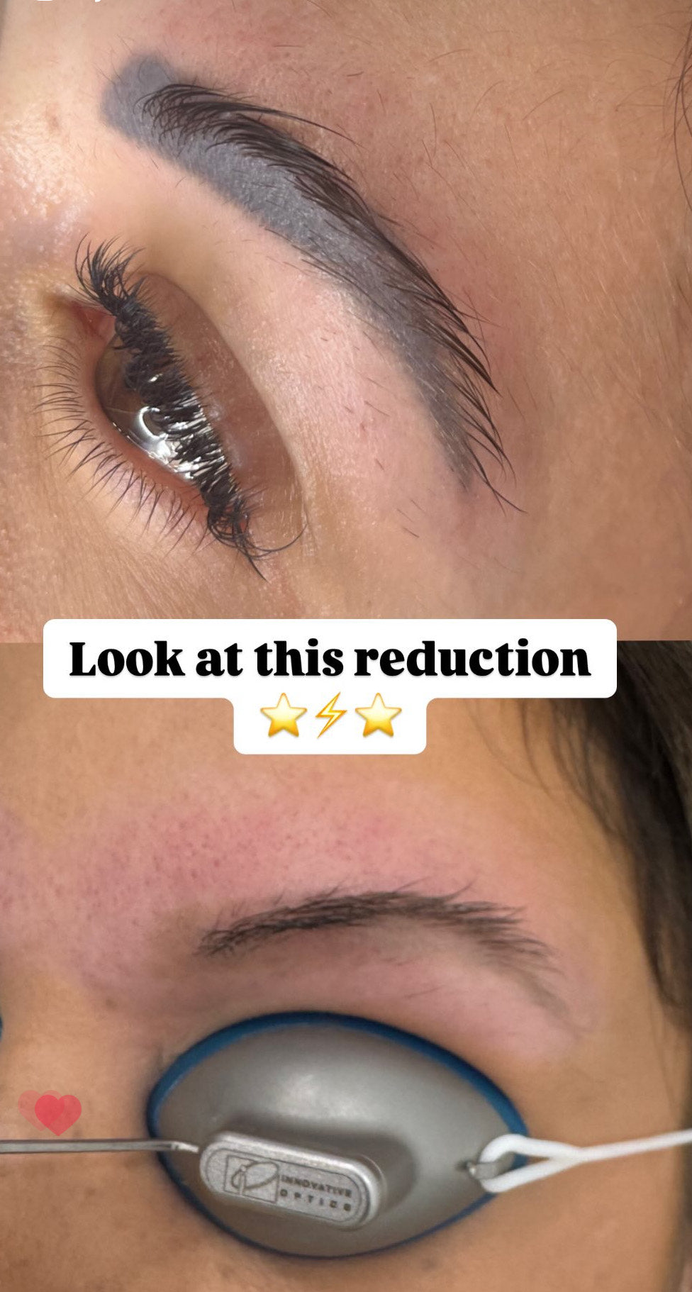 Eyebrow Tattoo Removal