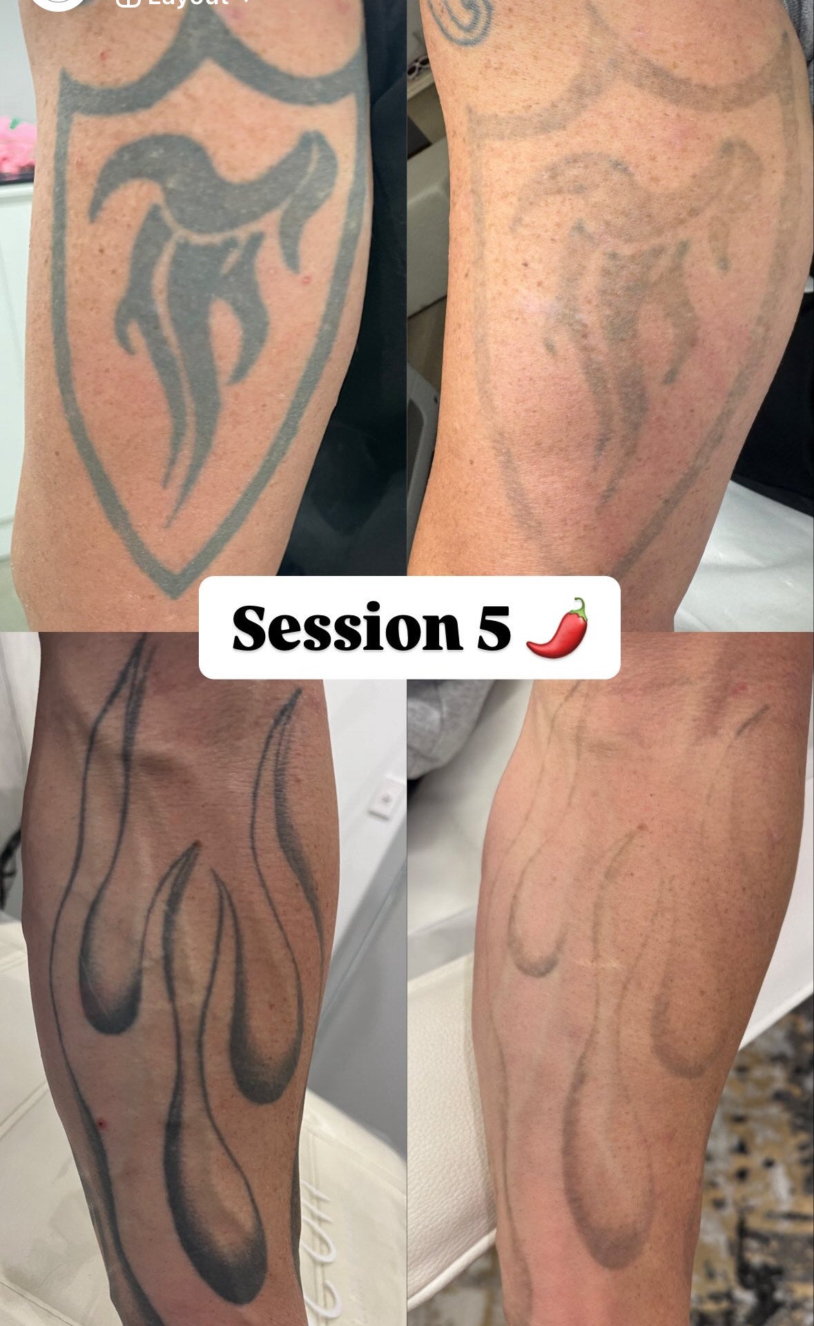 Tattoo Laser Removal