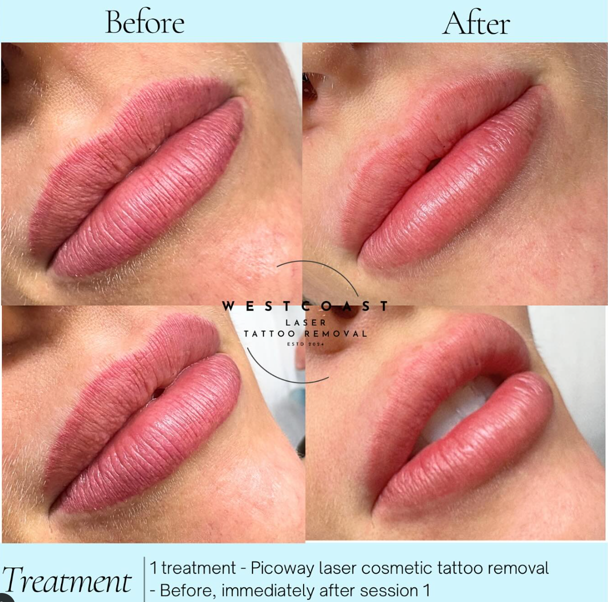 Lip Blush Tattoo Removal