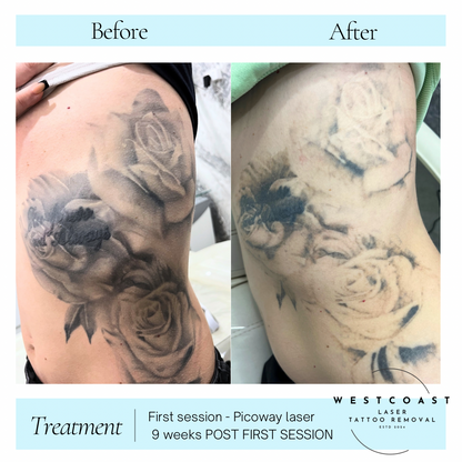 Tattoo Laser Removal