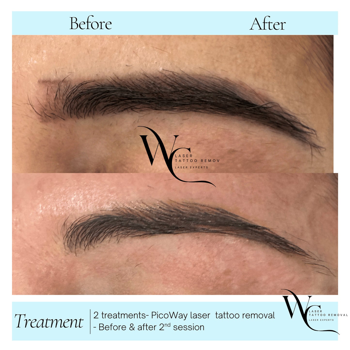 Eyebrow Tattoo Removal