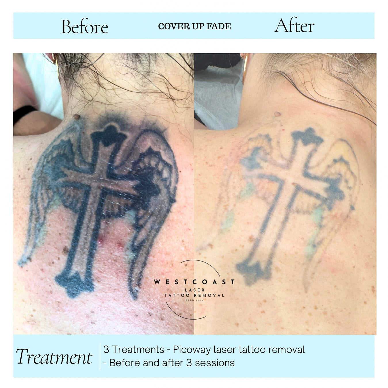 Tattoo Laser Removal