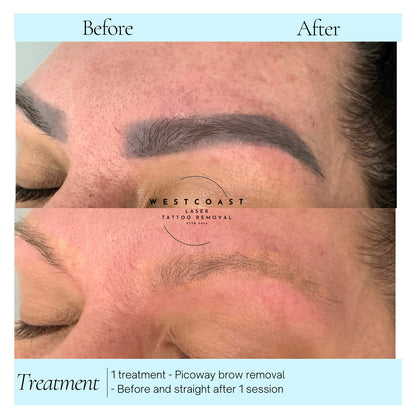 Eyebrow Tattoo Removal