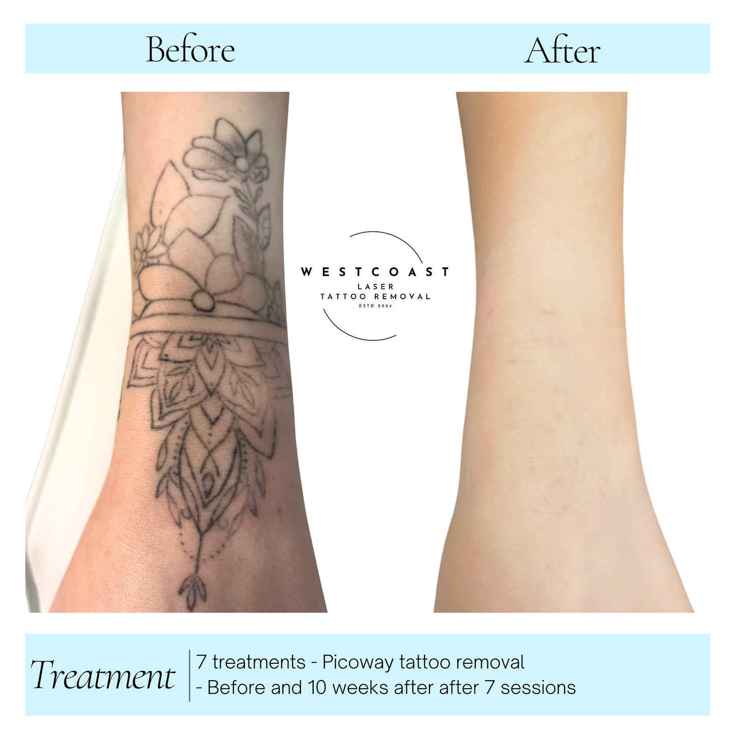 Tattoo Laser Removal