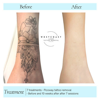 Tattoo Laser Removal