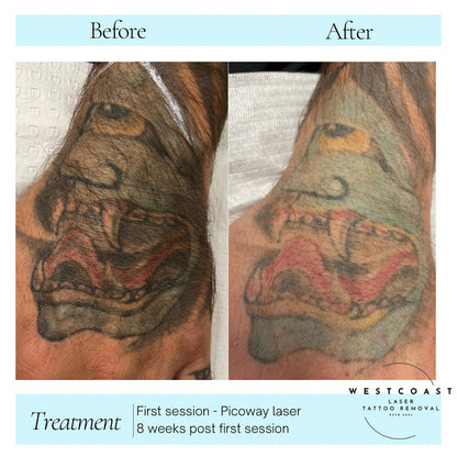 Tattoo Laser Removal