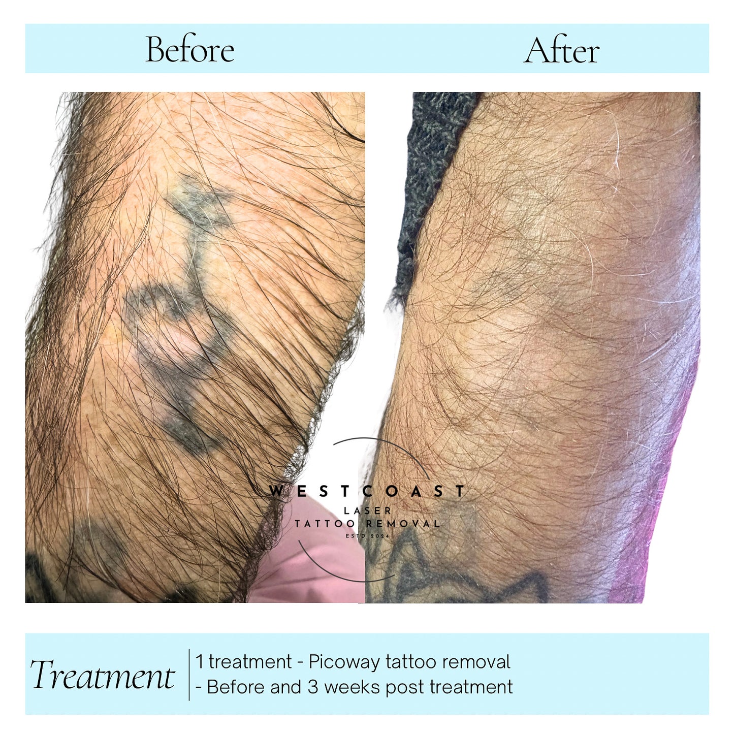 Tattoo Laser Removal