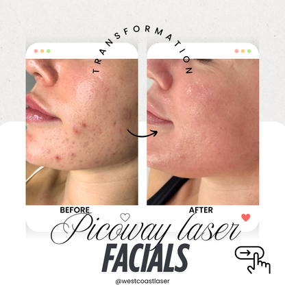 Laser Facials