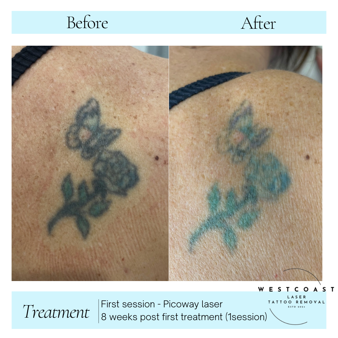 Tattoo Laser Removal