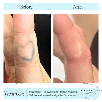 Tattoo Laser Removal