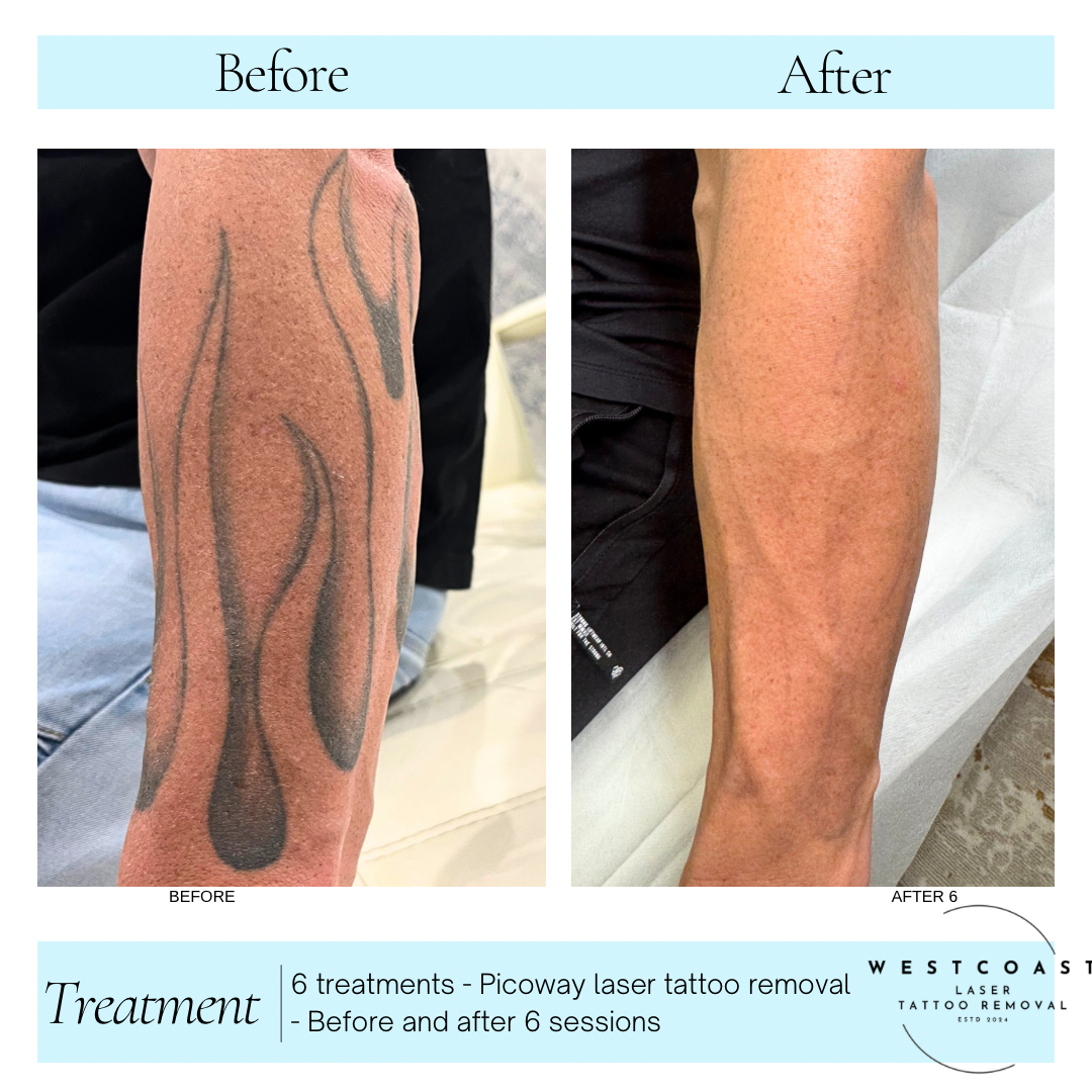 Tattoo Laser Removal