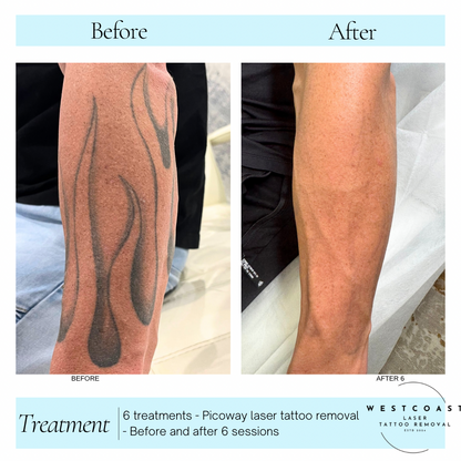 Tattoo Laser Removal