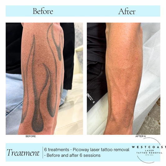 Tattoo Laser Removal