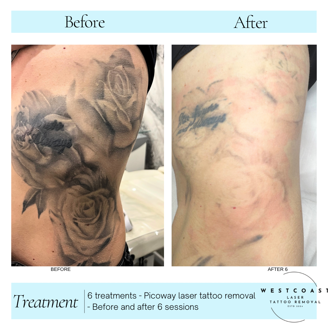 Tattoo Laser Removal