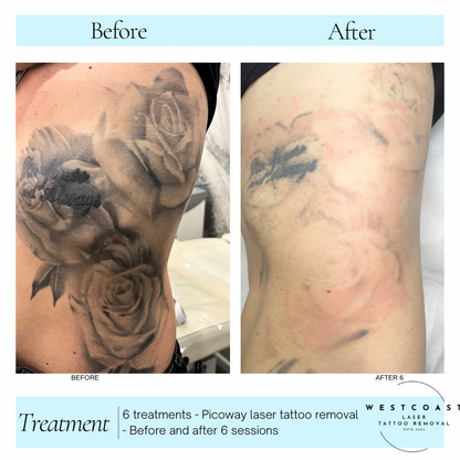 Tattoo Laser Removal
