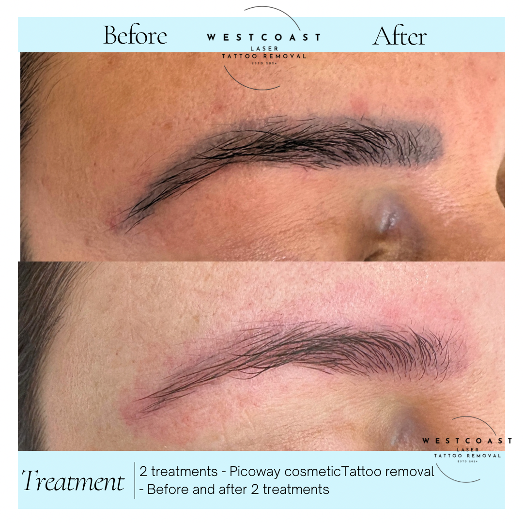 Eyebrow Tattoo Removal