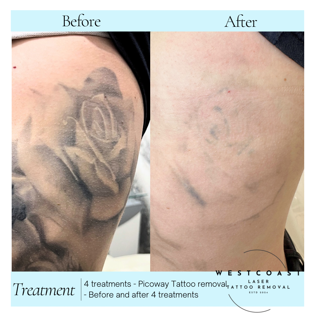 Tattoo Laser Removal
