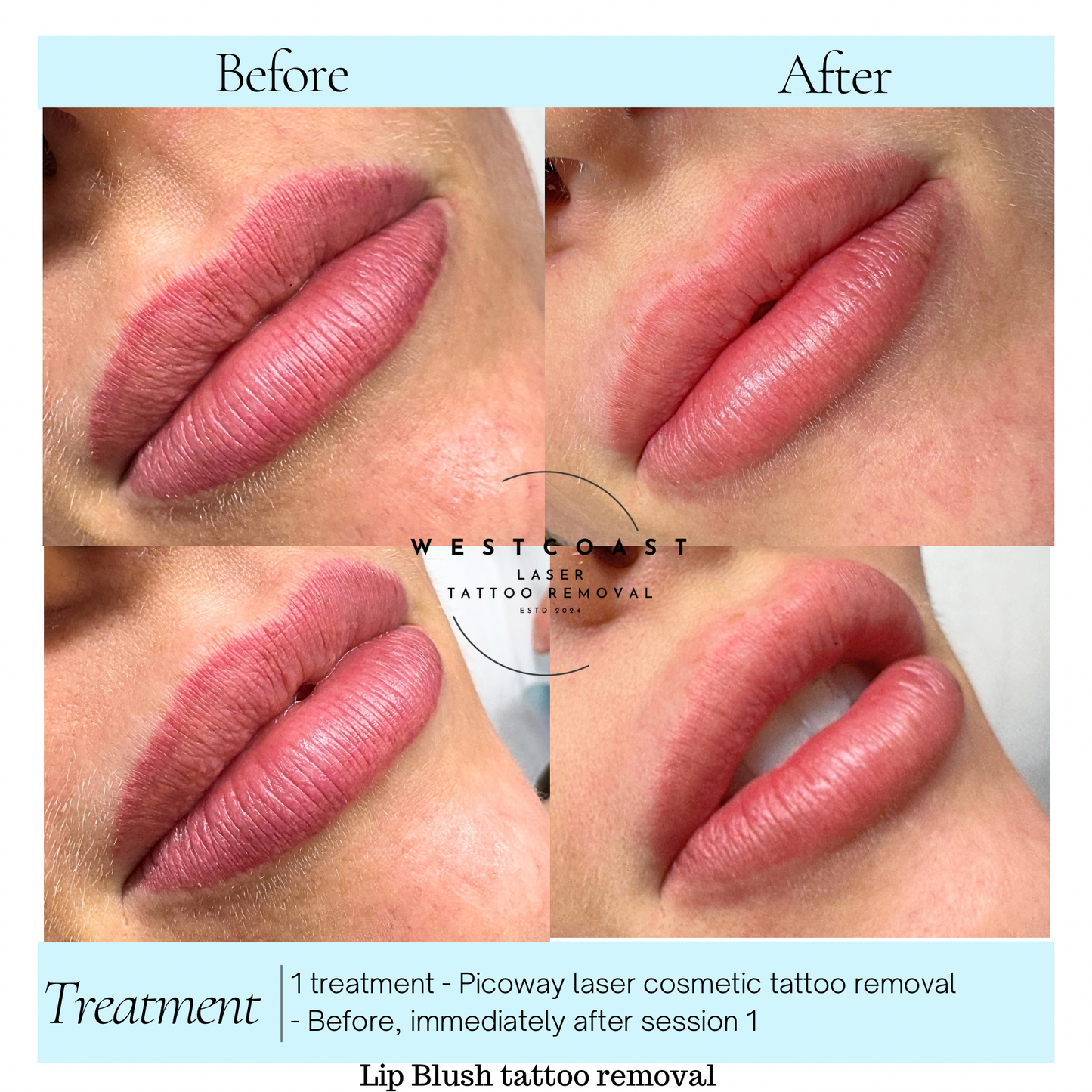 Lip Blush Tattoo Removal