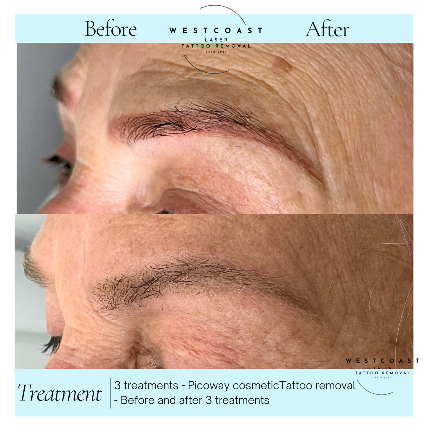 Eyebrow Tattoo Removal