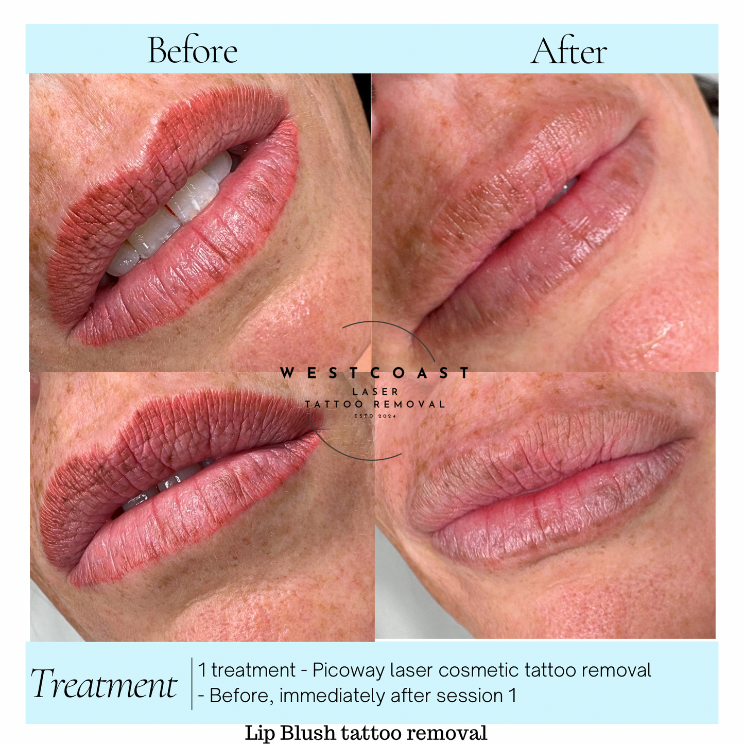 Lip Blush Tattoo Removal