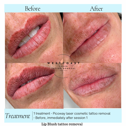 Lip Blush Tattoo Removal