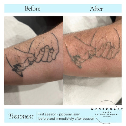 Tattoo Laser Removal