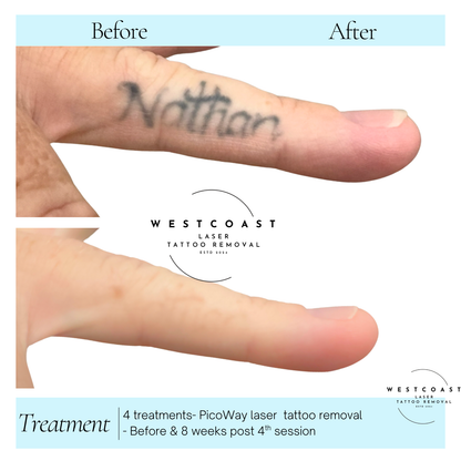 Tattoo Laser Removal