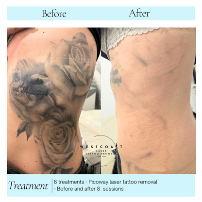 Tattoo Laser Removal