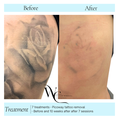 Tattoo Laser Removal
