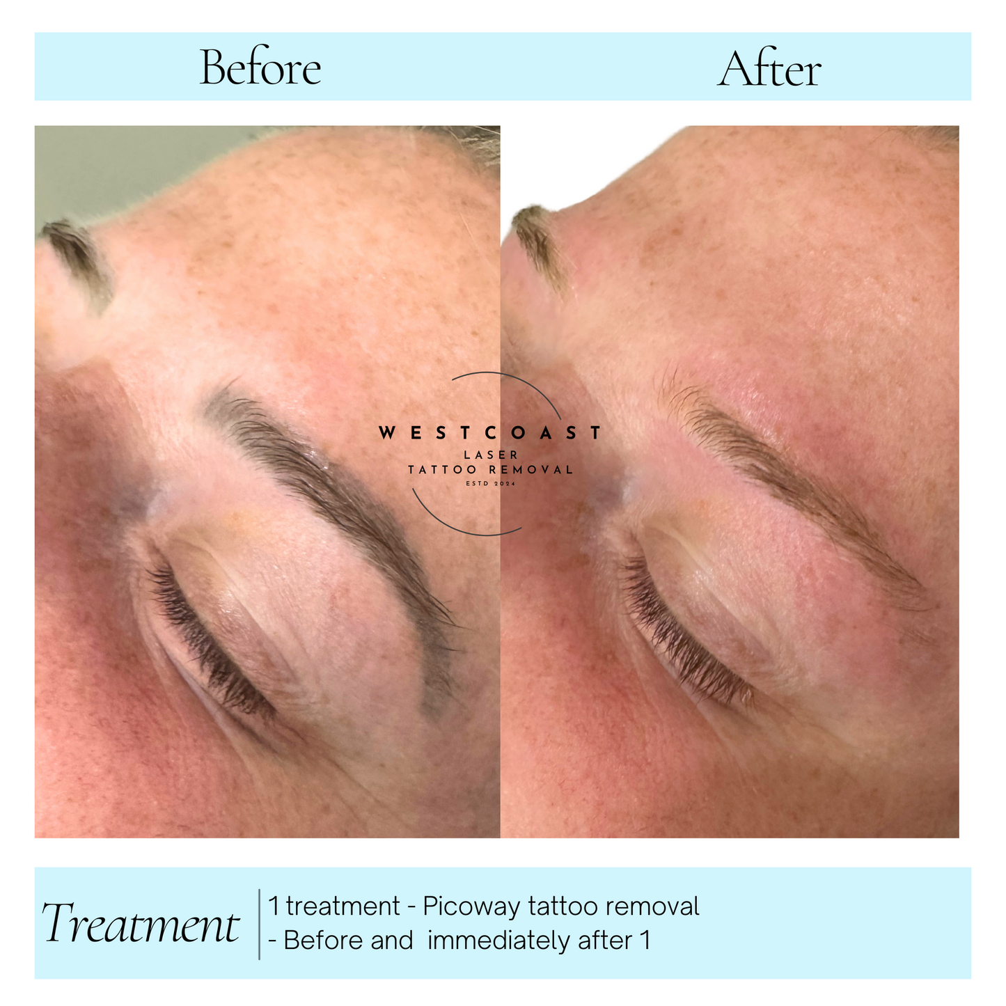 Eyebrow Tattoo Removal