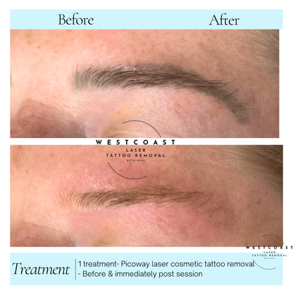 Eyebrow Tattoo Removal