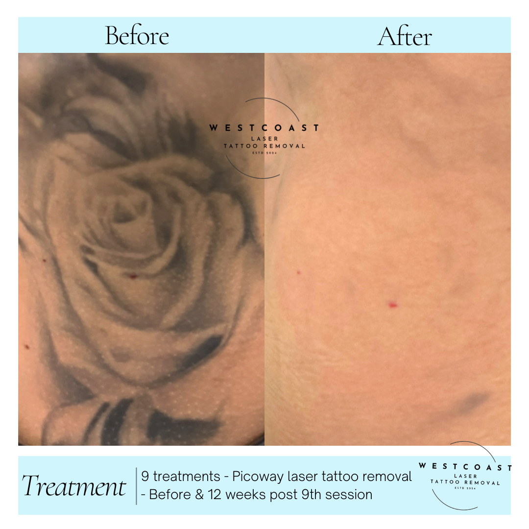 Tattoo Laser Removal