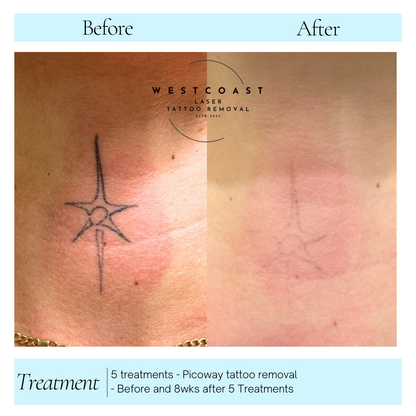 Tattoo Laser Removal