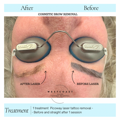 Eyebrow Tattoo Removal