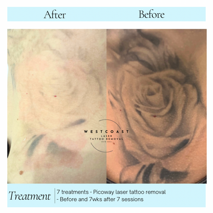 Tattoo Laser Removal