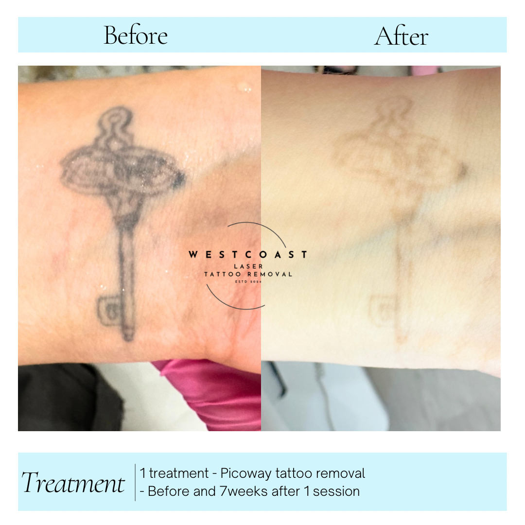 Tattoo Laser Removal