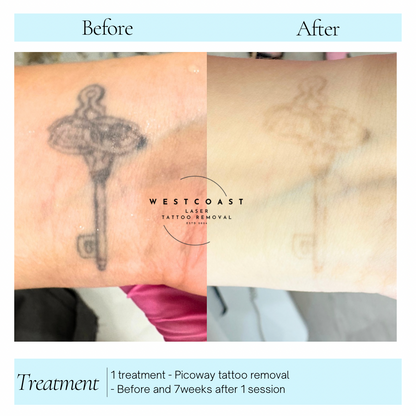 Tattoo Laser Removal