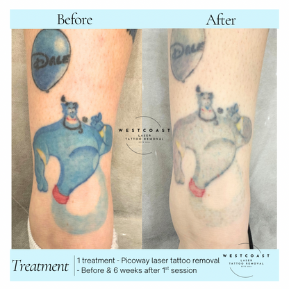 Tattoo Laser Removal