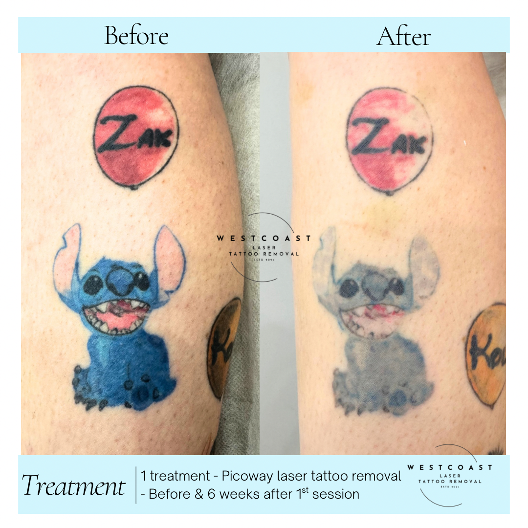 Tattoo Laser Removal