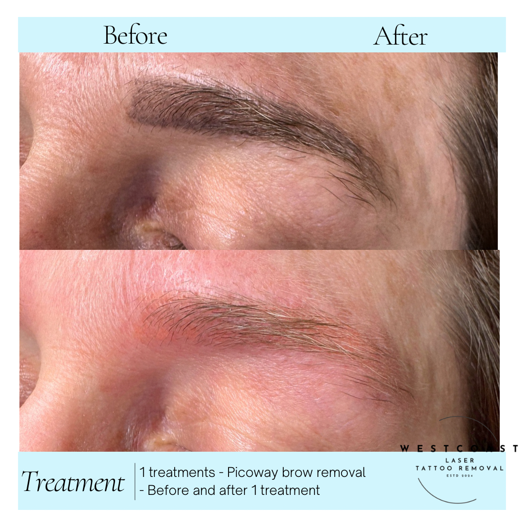 Eyebrow Tattoo Removal