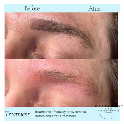 Eyebrow Tattoo Removal