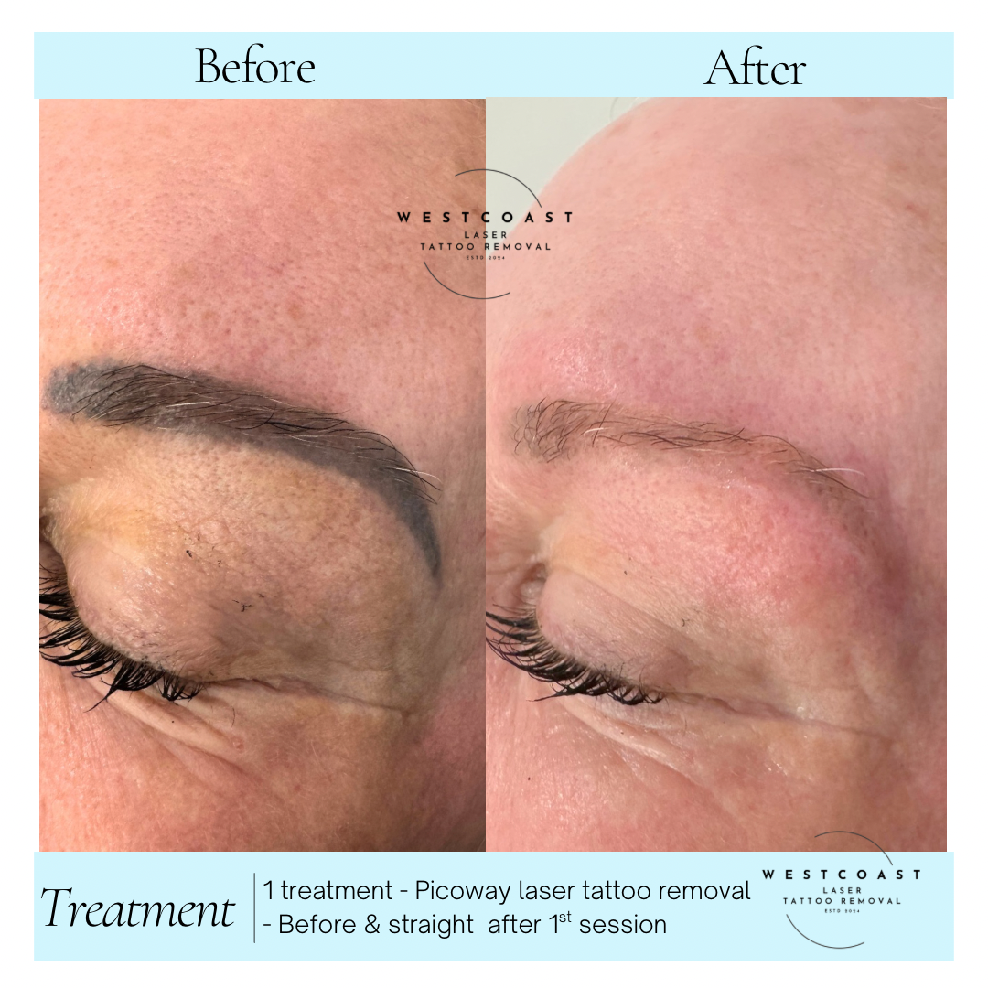 Eyebrow Tattoo Removal