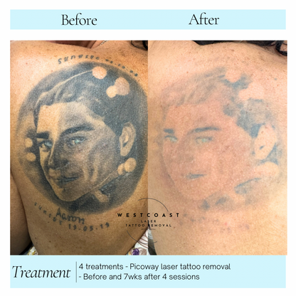 Tattoo Laser Removal