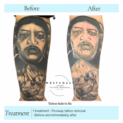 Tattoo Laser Removal