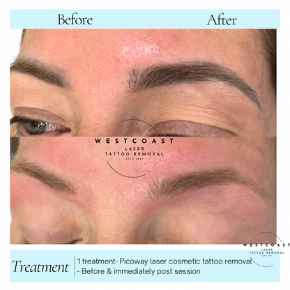 Eyebrow Tattoo Removal