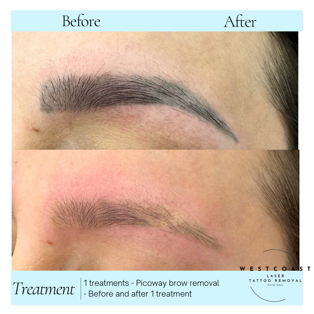 Eyebrow Tattoo Removal