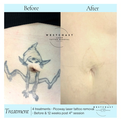 Tattoo Laser Removal