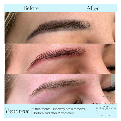 Eyebrow Tattoo Removal