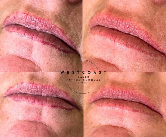 Lip Blush Tattoo Removal